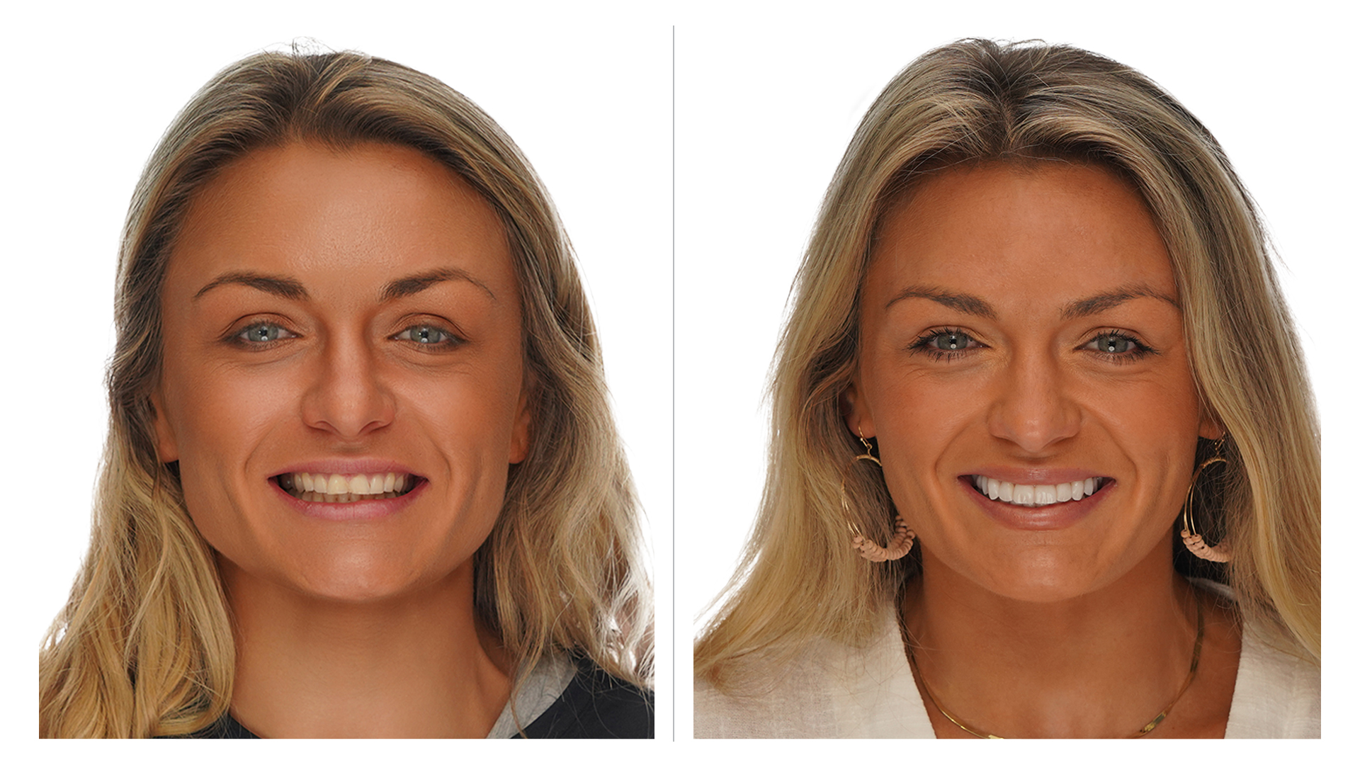 Smile Makeover Before and After